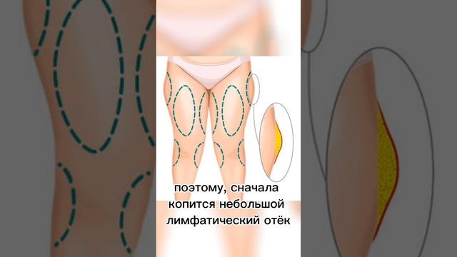 Целлюлит? Ушки на бедрах? Реальные причины!