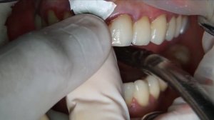 IDR / Socket Shield / M-guide