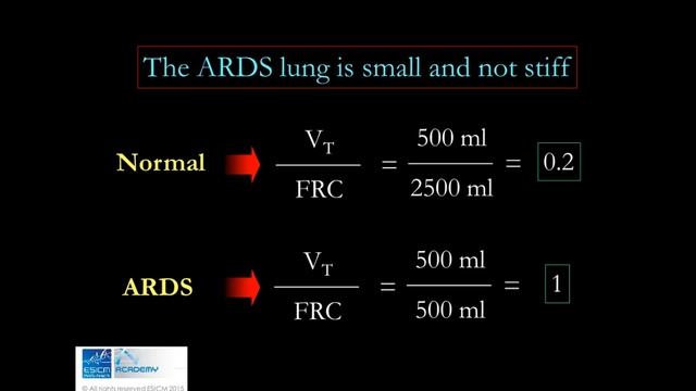 A basic introduction to the pathophysiology of ARDS  Luciano Gattinoni 2015
