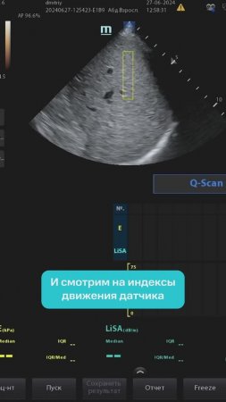 Как правильно выбрать участок печени для исследования на Hepatus