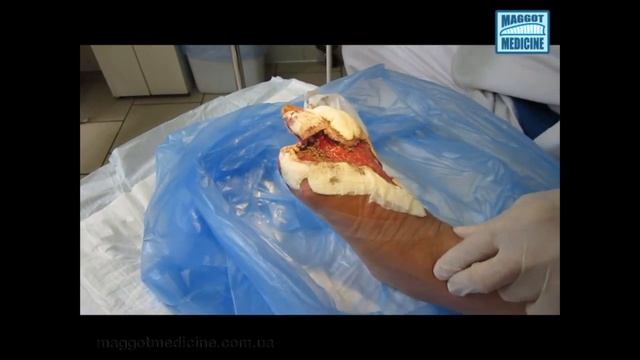 Лечение ран личинками. Диабетическая стопа / Maggot debritment therapy. Diabetic foot