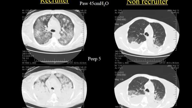A basic introduction to the pathophysiology of ARDS Luciano Gattinoni 2016