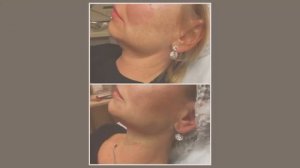 Нитевой лифтинг лица. Подтяжка лица без операции