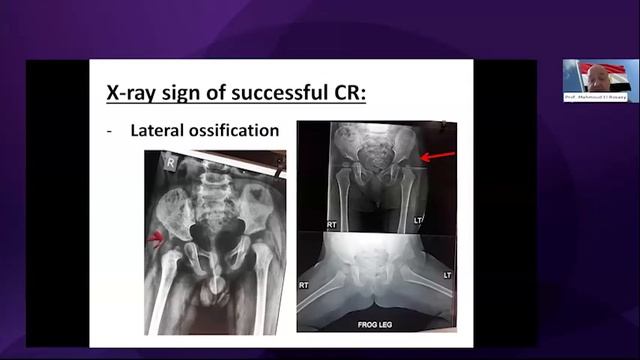 International hip webinar 3 смотреть онлайн