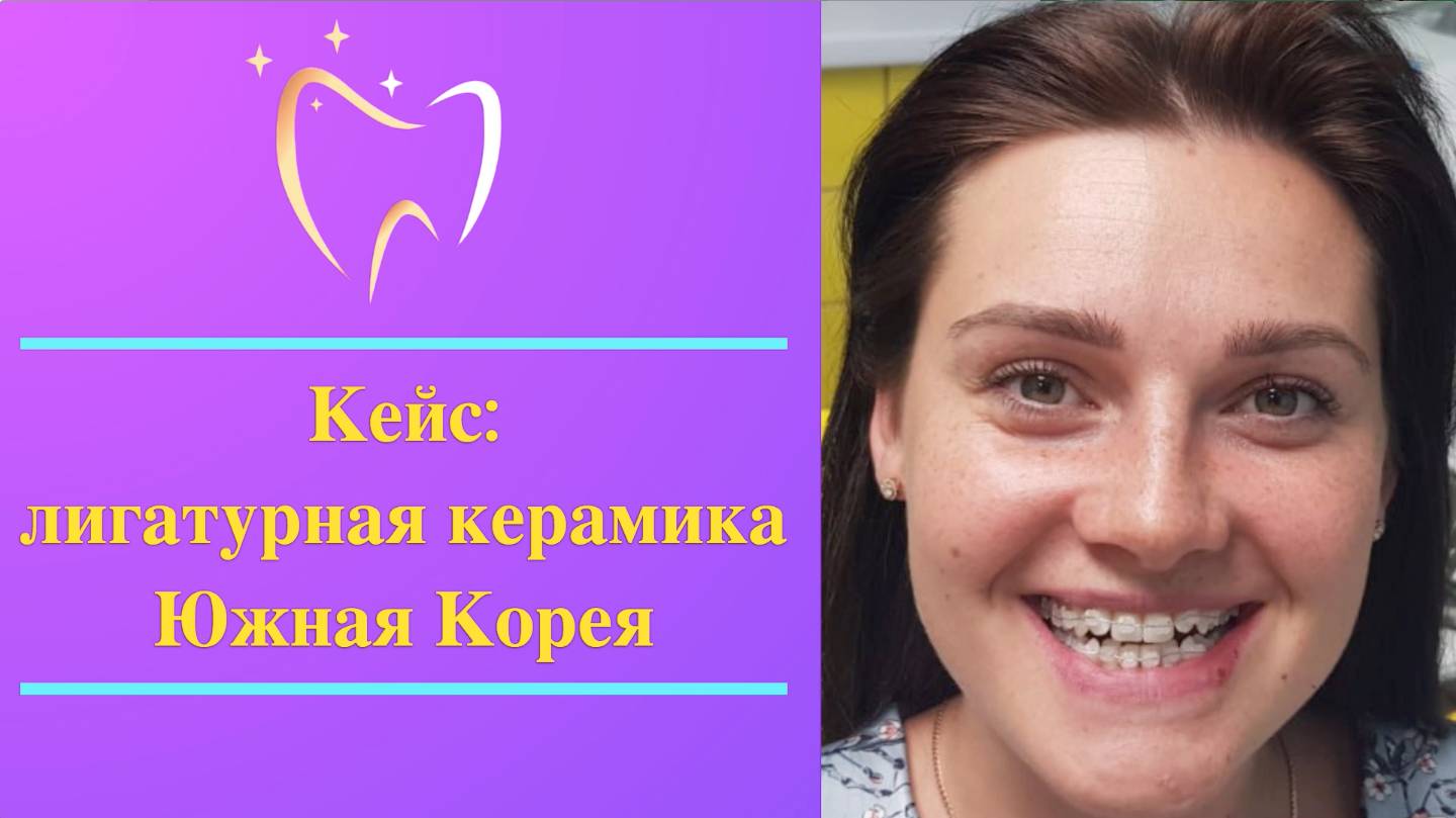 💎 Кейс: успешное лечение с керамическими брекетами Южной Кореи