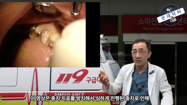충치 치료 미루다 패혈증으로 사망까지 이르는 경우 많아, 충치치료 미루지말고 제때 치료해야 하는 이유