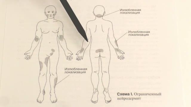 Нейродермит, атопический дерматит - лечение у детей