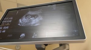 Первый скрининг🤰🏻👼🏻