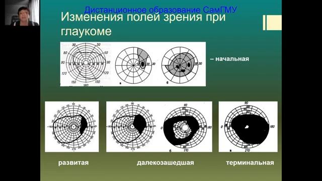 Глаукома  лекция  Часть 1   Кафедра офтальмологии им. Т.И. Ерошевского