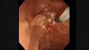 Папиллотом прекат