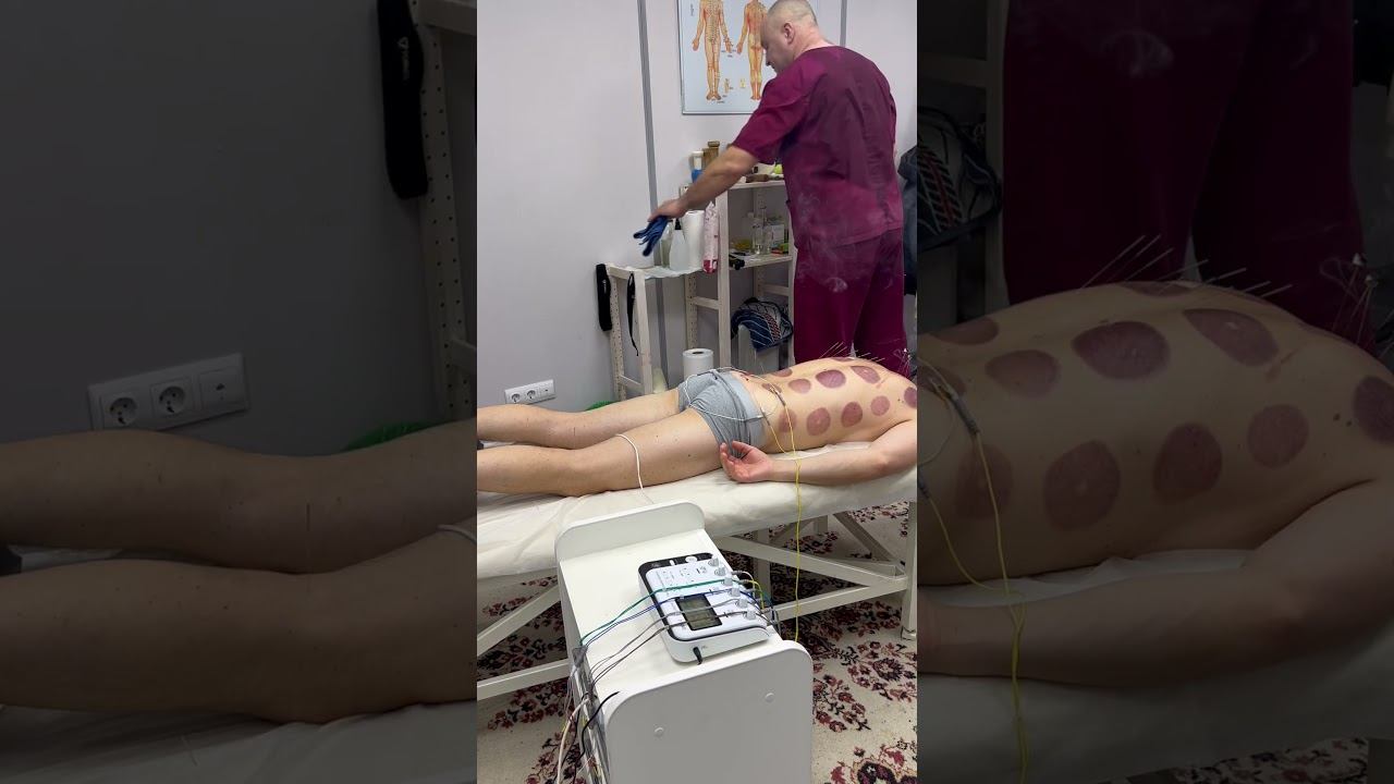 ASMR моксы и  электростимуляция Ростов на Дону 89614113110 #traditionalchinesemedicine #acupuncture