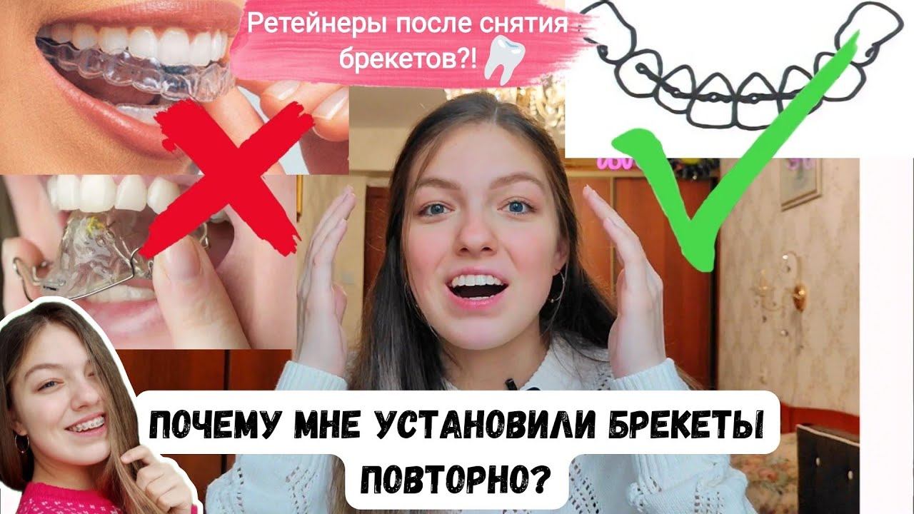 Почему мне установили БРЕКЕТЫ повторно?! РЕТЕЙНЕРЫ после снятия БРЕКЕТОВ?! Капы и пластинки
