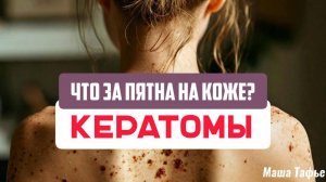 Кератомы: Что за пятна на коже? Причины появления и способы избавления. Зима с Машей ❄️ Видео №47