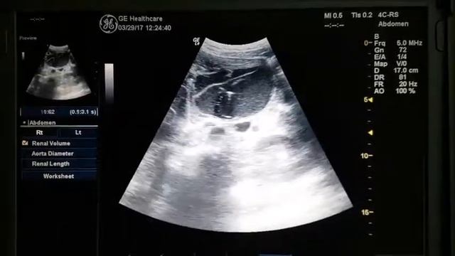 Дренирование некротически измененных метастазов
