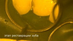 Скрытый кариес на передних зубах