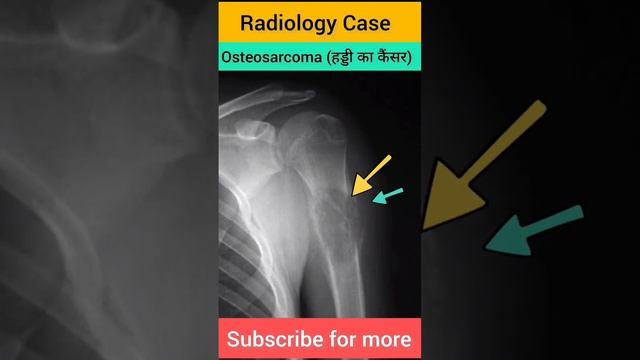#radiographer #paramedical #question #radiologycase #radiology #carcinoma #cancer #aiims #radio смотреть онлайн