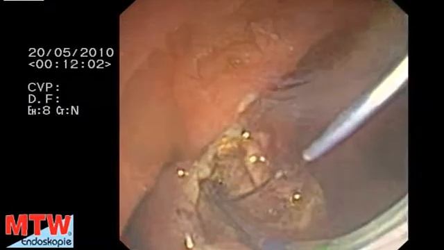 Папилотом Safe Cut c c частично изолированной струной MTW-Endoskopie смотреть онлайн