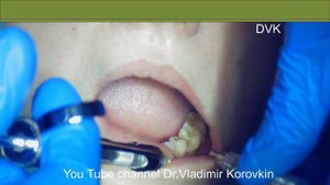 Проводниковая анестезия для удаления 36.#Alveolarinferiornerveblock