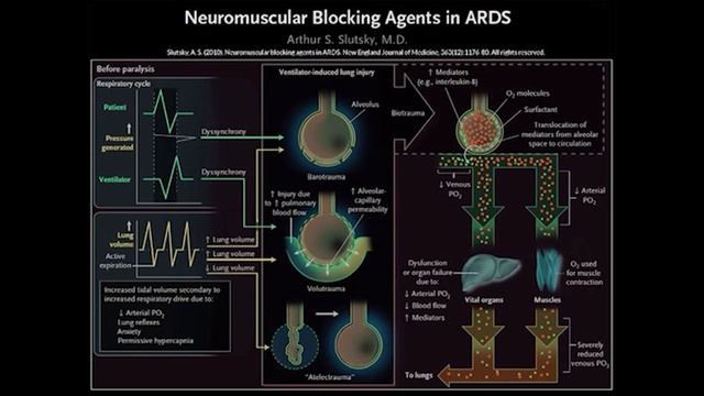 Why Spontaneous Breathing and Synchrony Matters, by Laurent Brochard