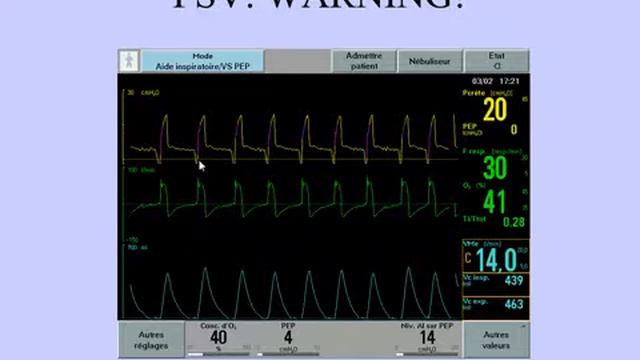ACUTE COR PULMONALE IN THE MECHANICALLY VENTILATED PATIENT CAUSES, TREATMENTS AN