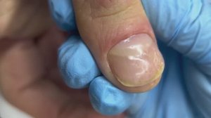 Как работать с псориазом в маникюре? // Восстановление ногтей ROSILAK