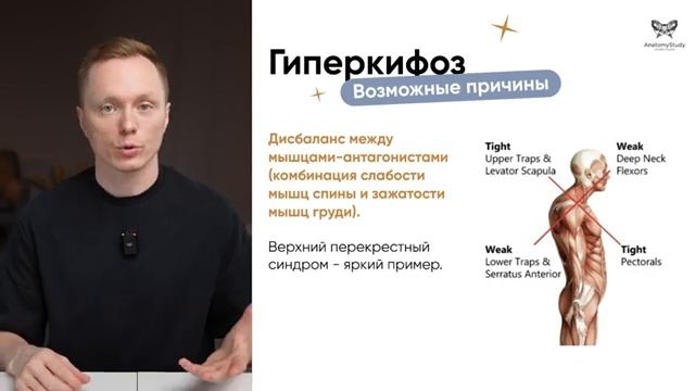 Как исправить сутулость 2024: Гиперкифоз