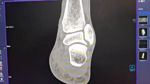 TC Calcâneo, indicado para visualizar melhor uma fratura no Siemens Somatom go.Up