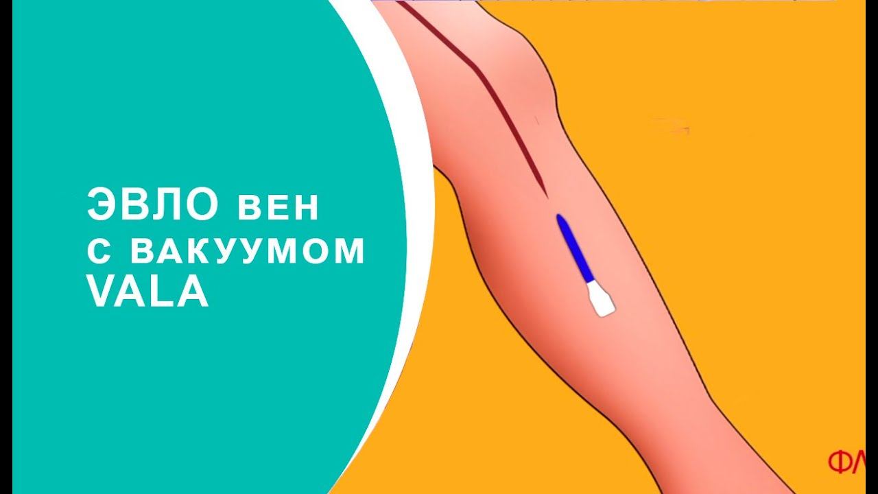 Лазерная облитерация вен с вакуумом VALA смотреть онлайн
