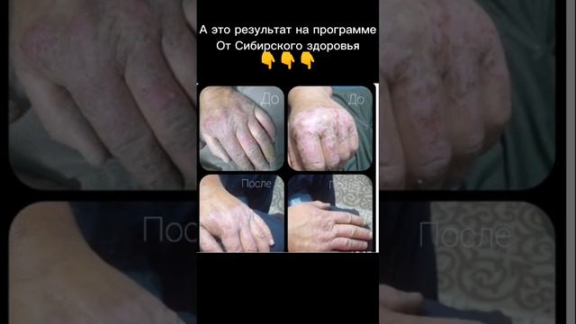 Считается, что псориаз не лечится. по вопросам пишите на вотсап/тг 79109053539