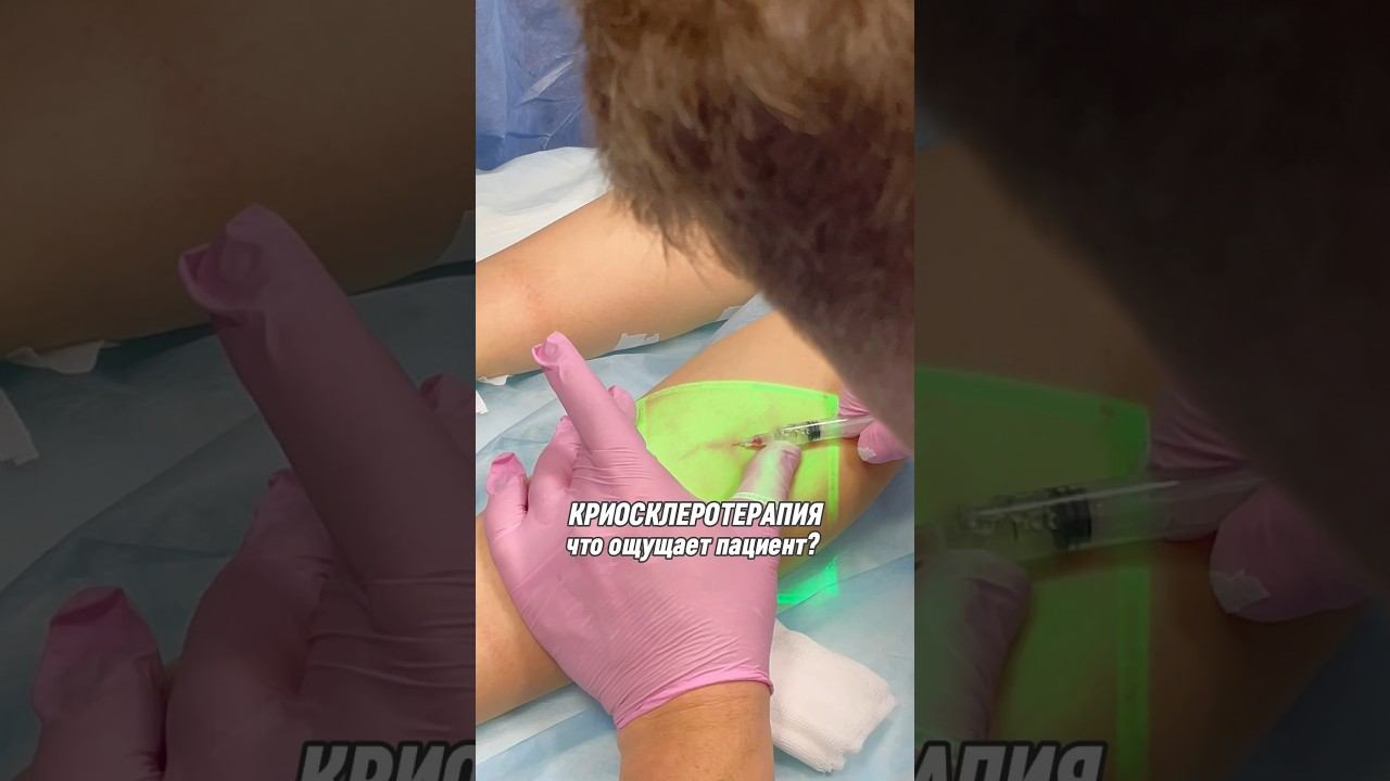 В нашем Центре лазерной хирургии выполняется инновационная методика КРИОСКЛЕРОТЕРАПИЯ✨ #флеболог смотреть онлайн
