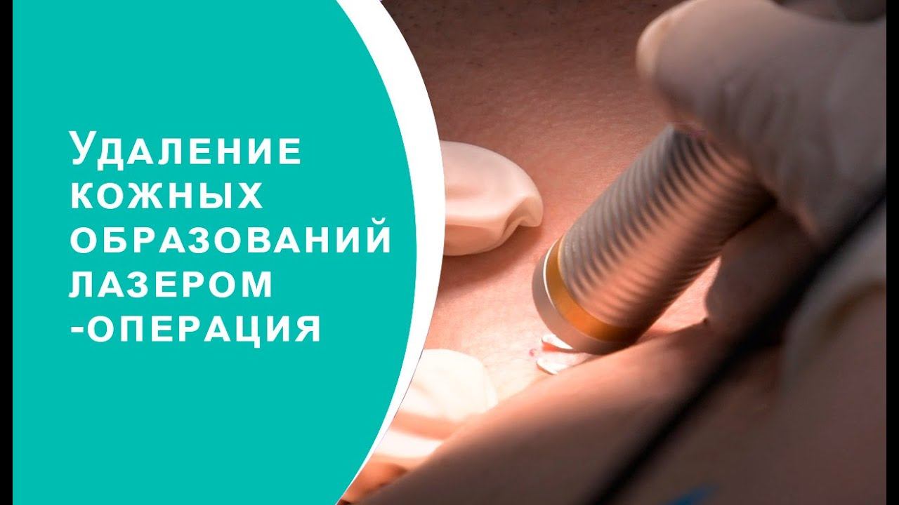 Удаление кожных образований лазером смотреть онлайн