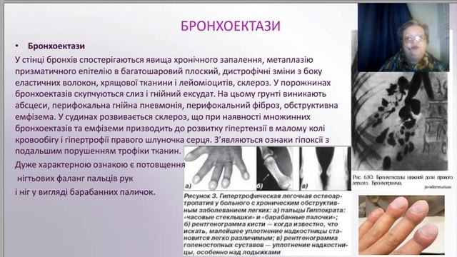 пат ан - патологія дихальної системи (пневмонія, бронхіт, емфізема, бронхіальна астма, пневмоторакс
