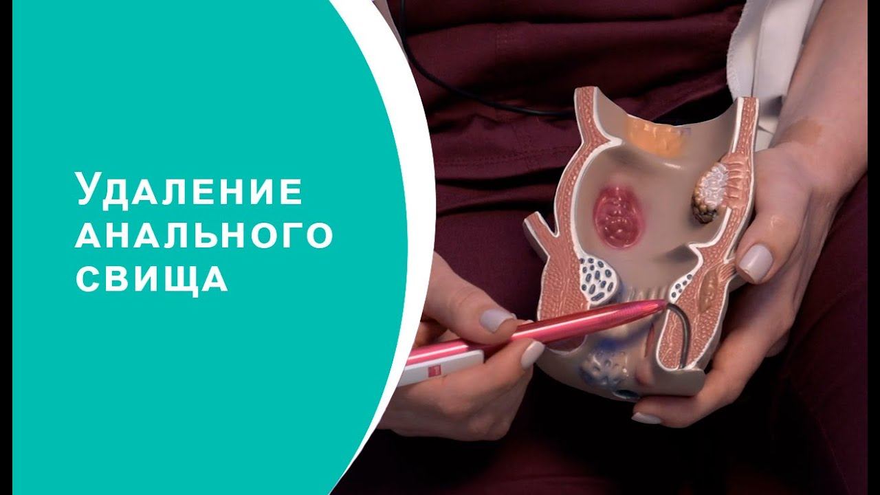 Удаление анального свища