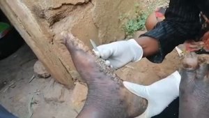 Jiggers eradication in schools and communities as a whole