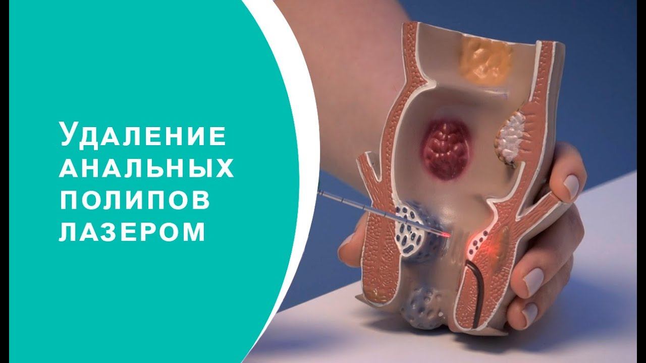Удаление анальных полипов лазером
