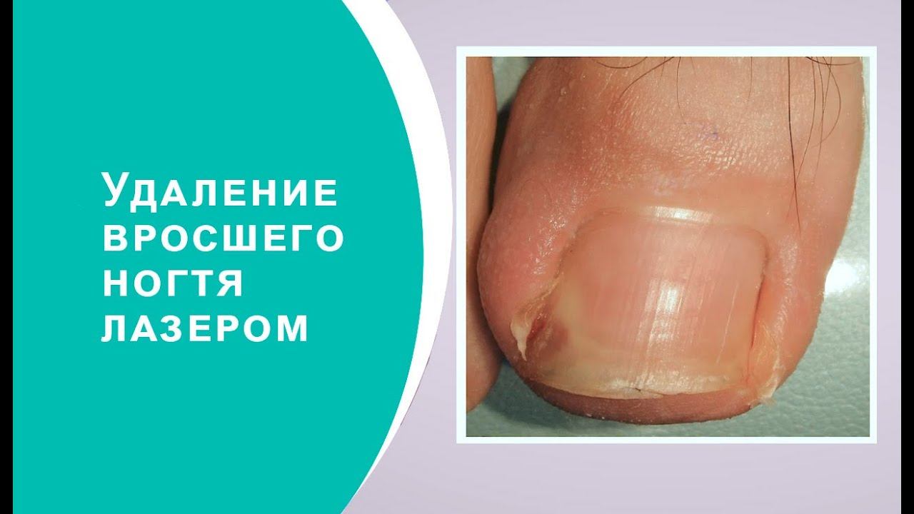 Удаление вросшего ногтя лазером