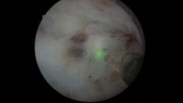 Holep уретротомия смотреть онлайн