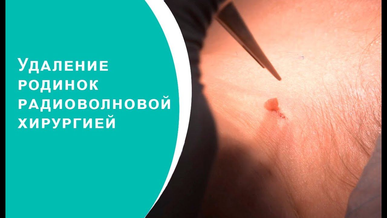 Удаление родинок радиоволновой хирургией