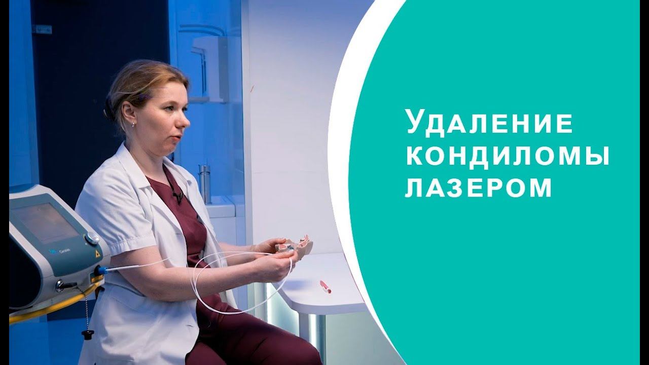 Удаление кандиломы лазером