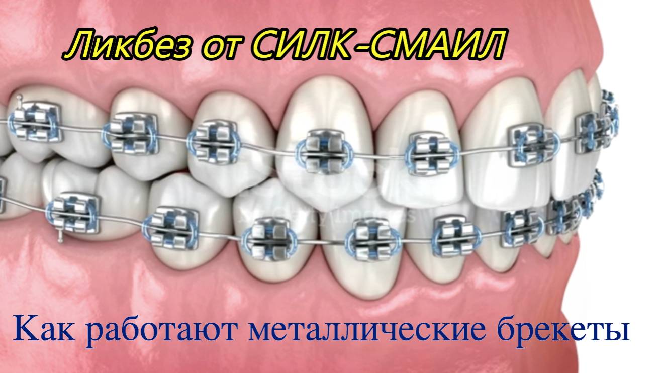 🛠 Как работают лигатурные металлические брекеты