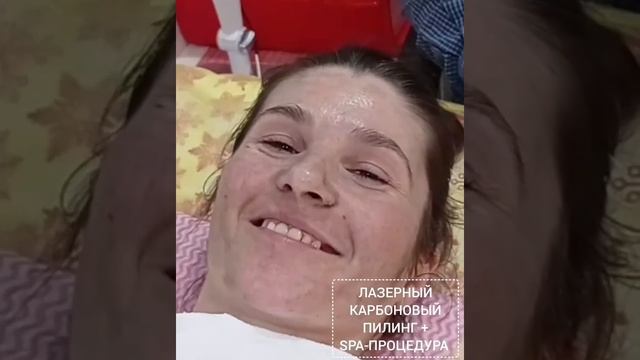 Лазерный карбоновый пилинг смотреть онлайн