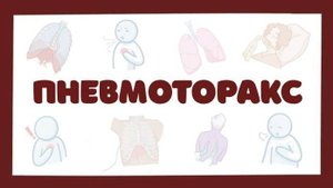 Пневмоторакс - причины, симптомы, лечение (хирургия) лекция
