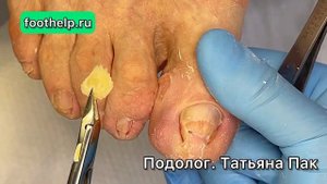 Мозоль в межпальцевом промежутке. Часть-2