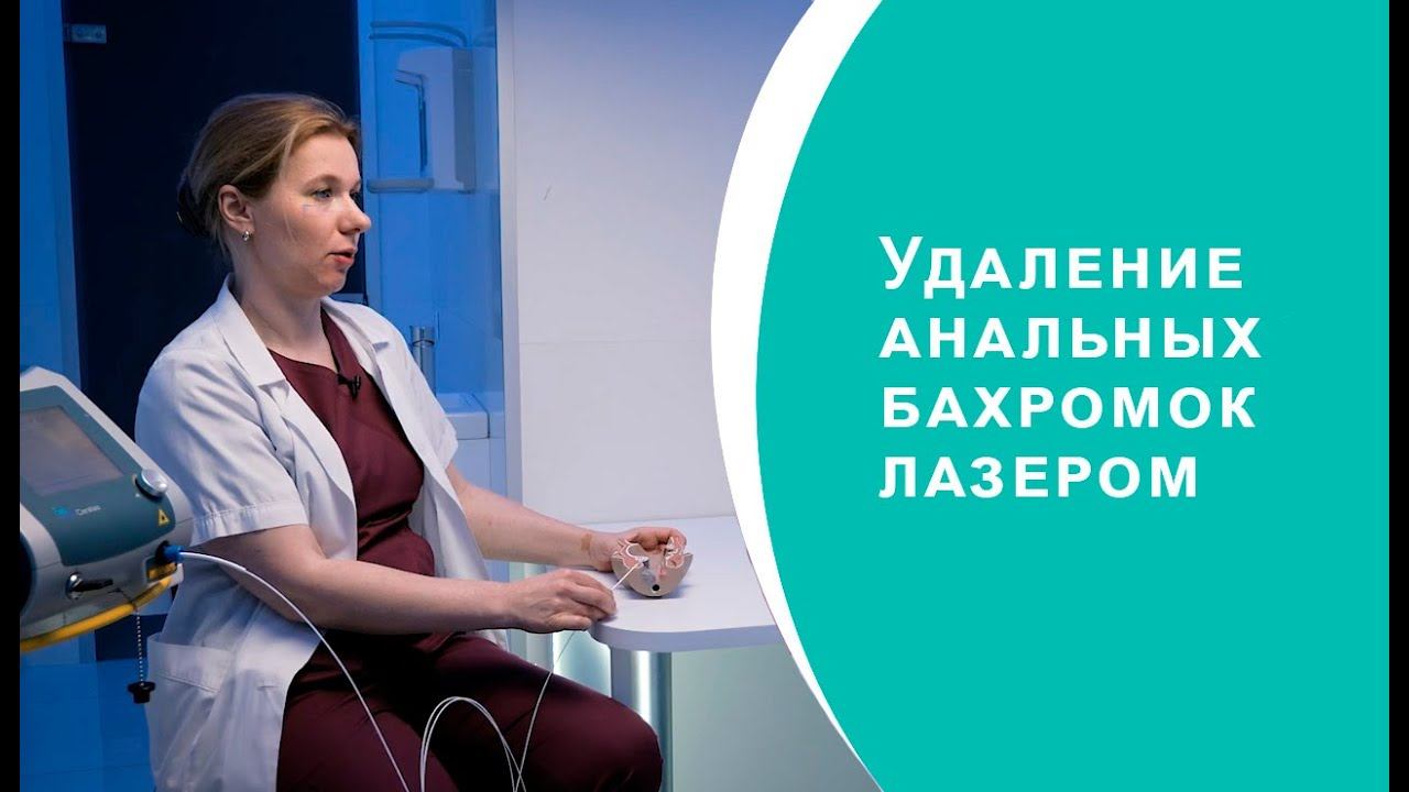Удаление анальных бахромок лазером