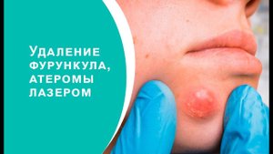 Удаление фурункула, атеромы лазером