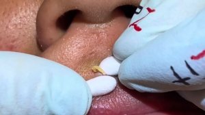 Top Pops volume 1. All kinds of pops from MrPopZit. Some new, some old.