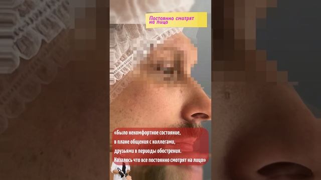 🔥 результат лечения #розацеа на сосудистом лазере  #Vbeam #чистаякожа #акне #здоровье
