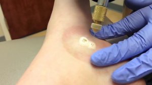 Удаление бородавки жидким азотом