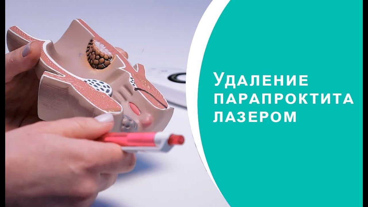 Удаление парапроктита лазером