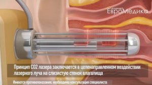 CO2 лазер Bioxel - Как это работает?